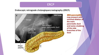 Endoscopic retrograde cholangiopancreatography (ERCP)
Mild pancreatitis
may present with
minimal dilation of
the main
pancreatic duct
and some clubbing
of the side
branches of the
duct
ERCP
 