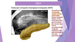 Chronic Pancreatitis
Endoscopic retrograde cholangiopancreatography (ERCP)
The patient with
moderately-
staged chronic
pancreatitis
shows moderate
dilation of the
main pancreatic
duct (1.5 times
the normal size)
This is
accompanied by
moderate
clubbing of the
side branches of
the main
pancreatic duct
ERCP
 