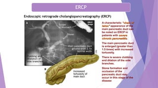 Chronic Pancreatitis
Endoscopic retrograde cholangiopancreatography (ERCP)
A characteristic "chain of
lakes" appearance of the
main pancreatic duct can
be noted on ERCP in
patients with severe
chronic pancreatitis.
The main pancreatic duct
is enlarged (greater than
1.5 times) with increased
tortuosity.
There is severe clubbing
and dilation of the side
branches.
Stone formation and
occlusion of the
pancreatic duct may
occur in this stage of the
disease
ERCP
 