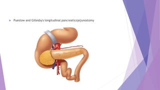 Puestow and Gillesby's longitudinal pancreaticojejunostomy
 