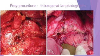 Frey procedure - intraoperative photographs
 