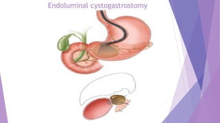 Endoluminal cystogastrostomy
 