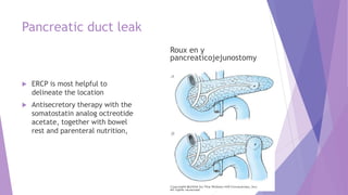 Pancreatic duct leak
 ERCP is most helpful to
delineate the location
 Antisecretory therapy with the
somatostatin analog octreotide
acetate, together with bowel
rest and parenteral nutrition,
Roux en y
pancreaticojejunostomy
 