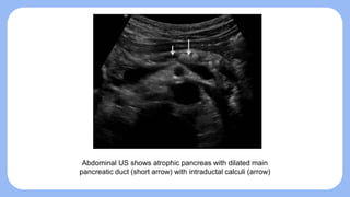 Chronic Pancreatitis (Lab and Instrumental Diagnosis).pptx