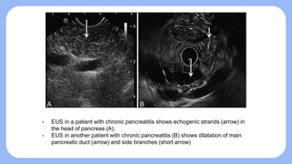 Chronic Pancreatitis (Lab and Instrumental Diagnosis).pptx