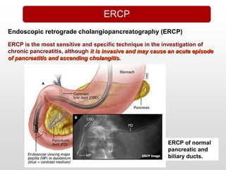 ERCP is the most sensitive and specific technique in the investigation of
chronic pancreatitis, although it is invasive and may cause an acute episode
of pancreatitis and ascending cholangitis.
Endoscopic retrograde cholangiopancreatography (ERCP)
ERCP of normal
pancreatic and
biliary ducts.
ERCP
 