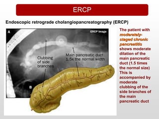 Chronic Pancreatitis
Endoscopic retrograde cholangiopancreatography (ERCP)
The patient with
moderately-
staged chronic
pancreatitis
shows moderate
dilation of the
main pancreatic
duct (1.5 times
the normal size)
This is
accompanied by
moderate
clubbing of the
side branches of
the main
pancreatic duct
ERCP
 