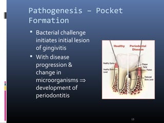 Pathogenesis – Pocket
Formation
 Bacterial challenge
initiates initial lesion
of gingivitis
 With disease
progression &
change in
microorganisms ⇒
development of
periodontitis
13
 
