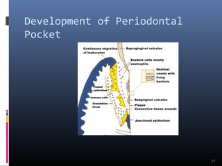 Development of Periodontal
Pocket
17
 