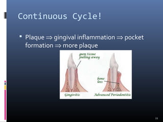 Continuous Cycle!
 Plaque ⇒ gingival inflammation ⇒ pocket
formation ⇒ more plaque
18
 