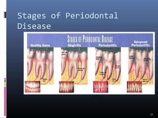 Stages of Periodontal
Disease
25
 
