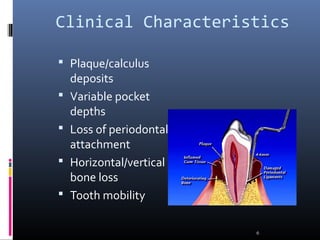 Clinical Characteristics
 Plaque/calculus
deposits
 Variable pocket
depths
 Loss of periodontal
attachment
 Horizontal/vertical
bone loss
 Tooth mobility
6
 