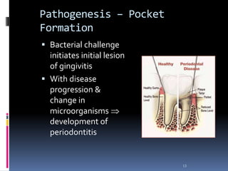 Pathogenesis – Pocket
Formation
 Bacterial challenge
initiates initial lesion
of gingivitis
 With disease
progression &
change in
microorganisms 
development of
periodontitis
13
 
