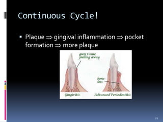 Continuous Cycle!
 Plaque  gingival inflammation  pocket
formation  more plaque
18
 