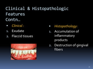 Clinical & Histopathologic
Features
Contn…
 Clinical :
1. Exudate
2. Flaccid tissues
 Histopathology:
1. Accumulation of
inflammatory
products
2. Destruction of gingival
fibers
24
 