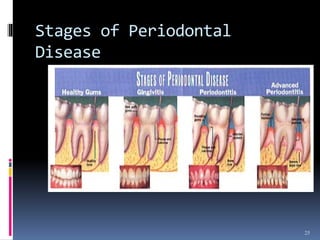 Stages of Periodontal
Disease
25
 