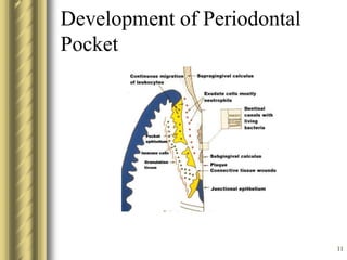 11
Development of Periodontal
Pocket
 