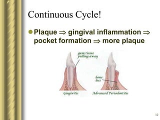 12
Continuous Cycle!
Plaque  gingival inflammation 
pocket formation  more plaque
 