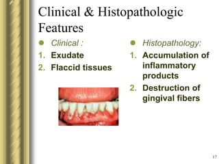 17
Clinical & Histopathologic
Features
 Clinical :
1. Exudate
2. Flaccid tissues
 Histopathology:
1. Accumulation of
inflammatory
products
2. Destruction of
gingival fibers
 