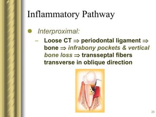 23
Inflammatory Pathway
 Interproximal:
– Loose CT  periodontal ligament 
bone  infrabony pockets & vertical
bone loss  transseptal fibers
transverse in oblique direction
 