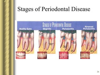 26
Stages of Periodontal Disease
 
