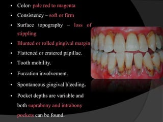 Chronic periodontitis | PPTX