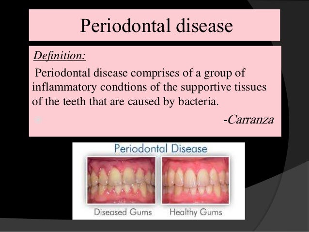 definition periodontal definition periodontal