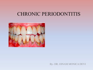 CHRONIC PERIODONTITIS
By- DR. OINAM MONICA DEVI
 