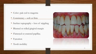 • Color- pale red to magenta
• Consistency – soft or firm
• Surface topography – loss of stippling
• Blunted or rolled gingival margin
• Flattened or cratered papillae.
• Furcation
• Tooth mobility
12
 