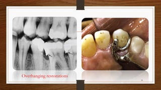 Overhanging restorations
28
 
