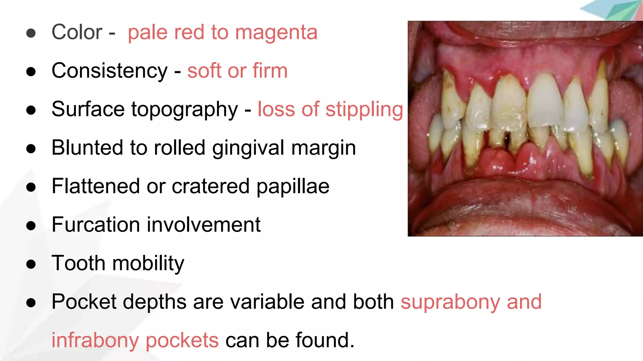 Chronic periodontitis | PPTX