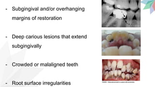 - Subgingival and/or overhanging
margins of restoration
- Deep carious lesions that extend
subgingivally
- Crowded or malaligned teeth
- Root surface irregularities
 