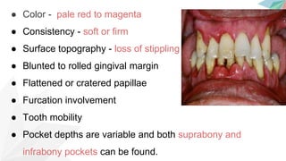 ● Color - pale red to magenta
● Consistency - soft or firm
● Surface topography - loss of stippling
● Blunted to rolled gingival margin
● Flattened or cratered papillae
● Furcation involvement
● Tooth mobility
● Pocket depths are variable and both suprabony and
infrabony pockets can be found.
 