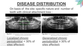 Localized chronic
periodontitis( < 30% of
sites affected)
DISEASE DISTRIBUTION
On basis of the site- specific nature and number of
teeth with clinical attachment loss :
Generalized chronic
periodontitis( ≥ 30% of
sites affected)
 