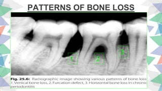 PATTERNS OF BONE LOSS
1 2
3
 