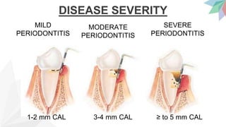 DISEASE SEVERITY
MILD
PERIODONTITIS
≥ to 5 mm CAL
3-4 mm CAL
1-2 mm CAL
SEVERE
PERIODONTITIS
MODERATE
PERIODONTITIS
 