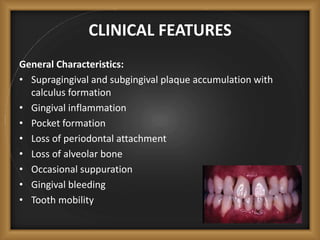 CLINICAL FEATURES
General Characteristics:
• Supragingival and subgingival plaque accumulation with
calculus formation
• Gingival inflammation
• Pocket formation
• Loss of periodontal attachment
• Loss of alveolar bone
• Occasional suppuration
• Gingival bleeding
• Tooth mobility
 