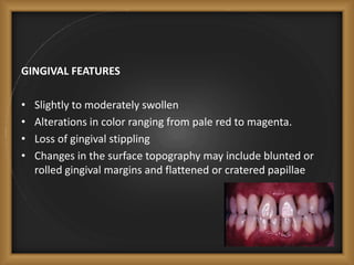 GINGIVAL FEATURES
• Slightly to moderately swollen
• Alterations in color ranging from pale red to magenta.
• Loss of gingival stippling
• Changes in the surface topography may include blunted or
rolled gingival margins and flattened or cratered papillae
 