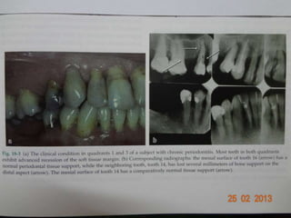 chronic periodontitis.pptx