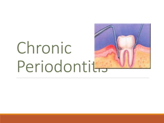 Chronic
Periodontitis
1
 