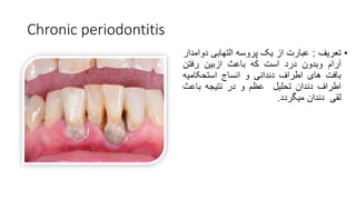 Chronic periodontitis
•
‫تعریف‬
:
‫عبارت‬
‫از‬
‫یک‬
‫پروسه‬
‫التهابی‬
‫دوام‬
‫دار‬
‫آرام‬
‫وبدون‬
‫درد‬
‫است‬
‫که‬
‫باعث‬
‫ازبین‬
‫رفتن‬
‫بافت‬
‫های‬
‫اطراف‬
‫دندانی‬
‫و‬
‫انساج‬
‫استحکامیه‬
‫اطراف‬
‫دندان‬
‫تحلیل‬
‫عظم‬
‫و‬
‫در‬
‫نتیجه‬
‫باعث‬
‫لقی‬
‫دندان‬
‫میگردد‬
.
 