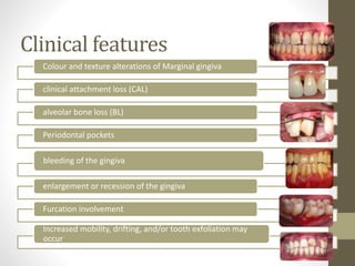 Clinical features
Colour and texture alterations of Marginal gingiva
clinical attachment loss (CAL)
alveolar bone loss (BL)
Periodontal pockets
bleeding of the gingiva
enlargement or recession of the gingiva
Furcation involvement
Increased mobility, drifting, and/or tooth exfoliation may
occur
 