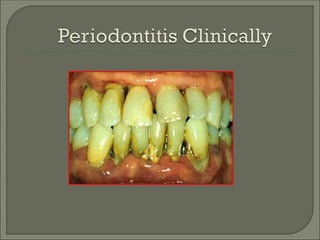 chronic periodontitis, classification, treatment | PPT
