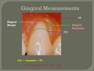 chronic periodontitis, classification, treatment | PPT