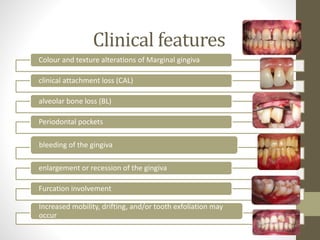 Clinical features
Colour and texture alterations of Marginal gingiva
clinical attachment loss (CAL)
alveolar bone loss (BL)
Periodontal pockets
bleeding of the gingiva
enlargement or recession of the gingiva
Furcation involvement
Increased mobility, drifting, and/or tooth exfoliation may
occur
 
