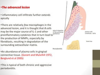 •The advanced lesion
• inflammatory cell infiltrate further extends
apically
•There are relatively few macrophages in the
advanced lesion, and it is thought that B cells
may be the major source of IL-1 and other
proinflammatory cytokines that in turn lead to
the production of MMPs, especially by
fibroblasts, resulting in degradation of the
surrounding extracellular matrix.
•An abundance of plasma cells in gingival
connective tissue. (Garant and Mulvihill 1972,
Berglund et al 2005)
•This is typical of both chronic and aggressive
periodontitis.
 