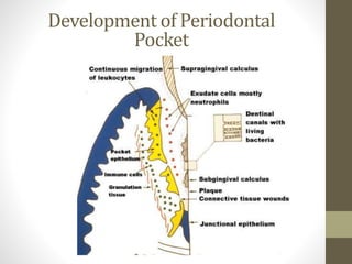 Development of Periodontal
Pocket
 