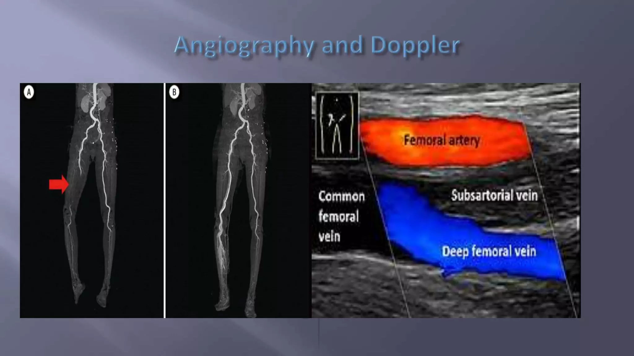 Chronic peripheral arterial occlusive disease( lower limb) | PPTX ...