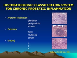 Advancement in prostate cancer | PPT