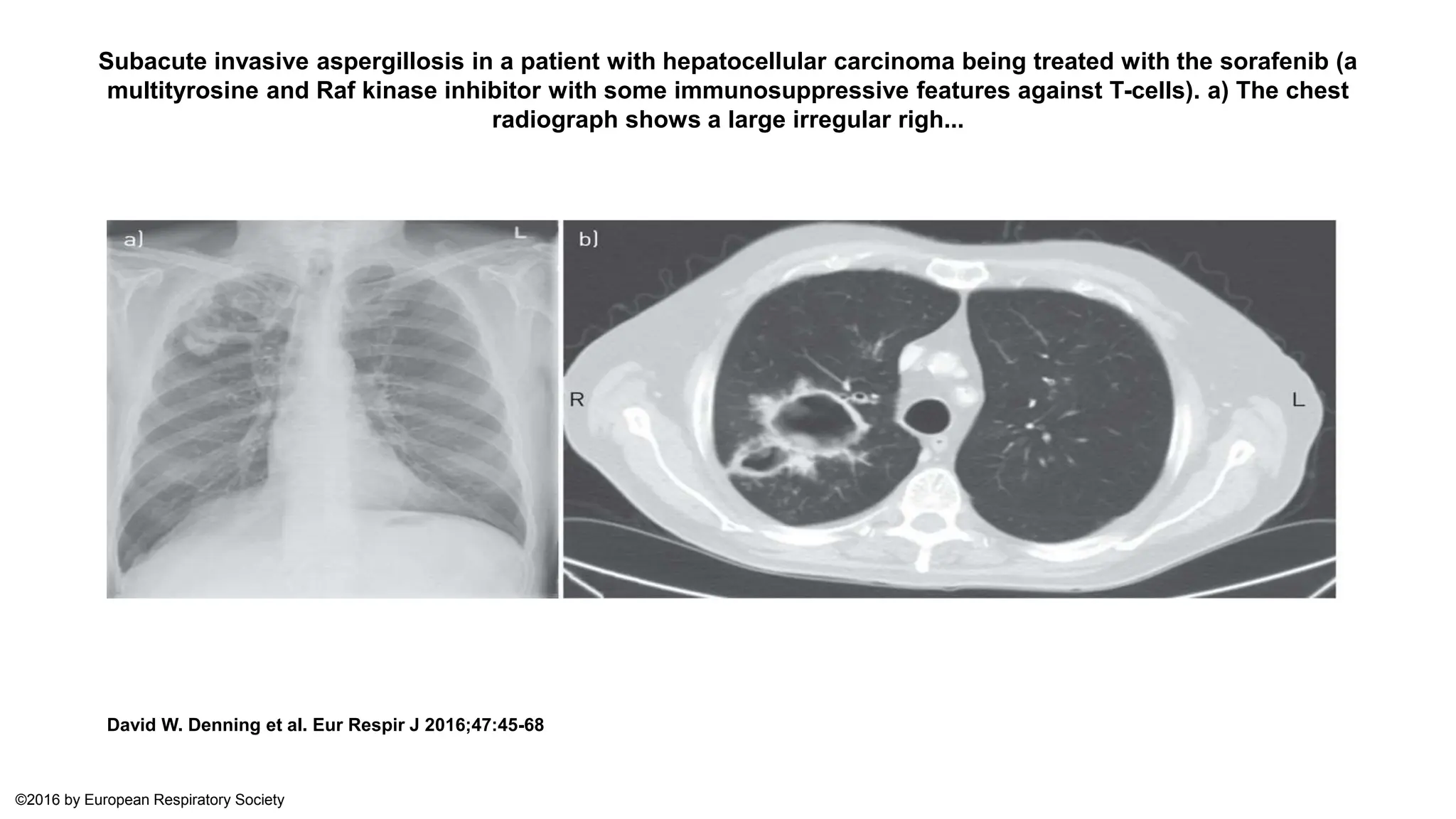 Presentation on Chronic Pulmonary Aspergillosis | PPTX